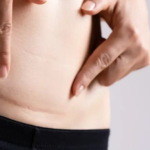 AdobeStock_330672672 (3) Close-up of a woman pointing to her own caesarean section scar.