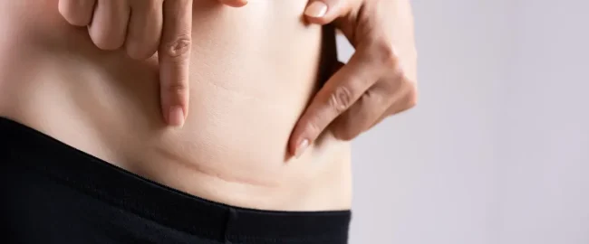 Close-up of a woman pointing to her own caesarean section scar.