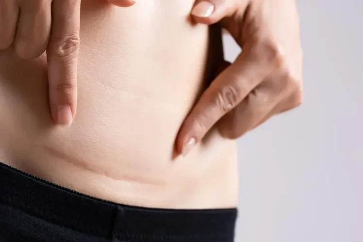 AdobeStock_330672672 (3) Close-up of a woman pointing to her own caesarean section scar.
