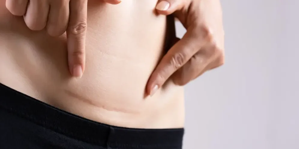 AdobeStock_330672672 (3) Close-up of a woman pointing to her own caesarean section scar.