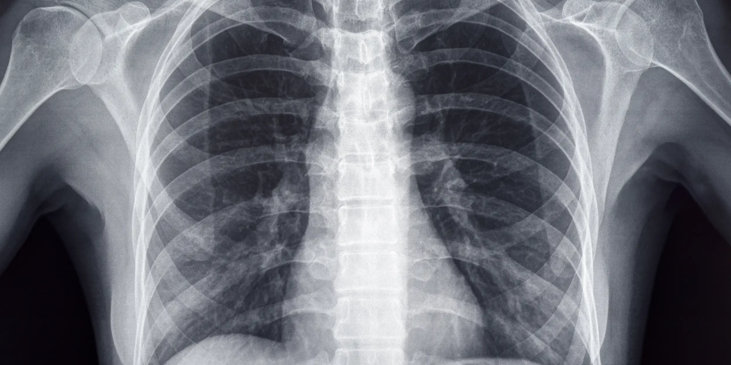 A chest x-ray of an adult human.